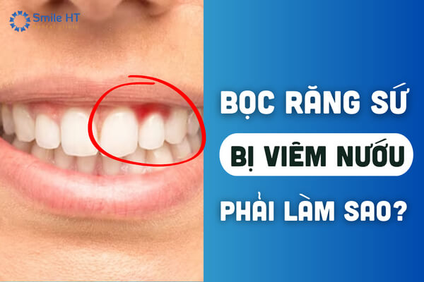 Ảnh bìa bài viết về bọc răng sứ bị viêm nướu