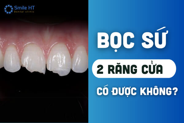 Ảnh bìa bài viết về bọc sứ 2 răng cửa