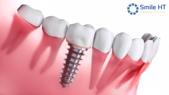 Mô hình cấy ghép Implant thay thế một răng đã mất