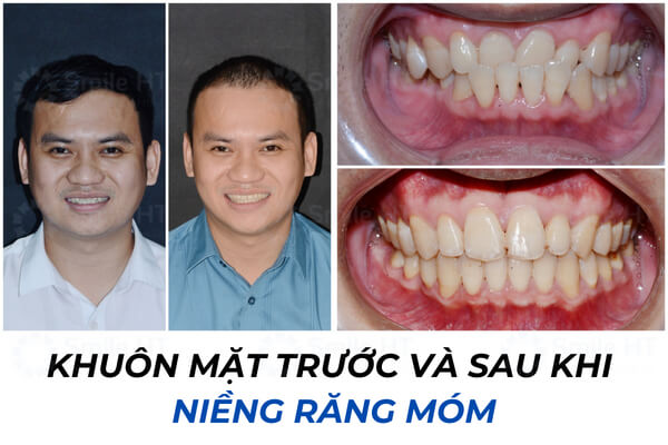 Trước và sau khi niềng răng móm