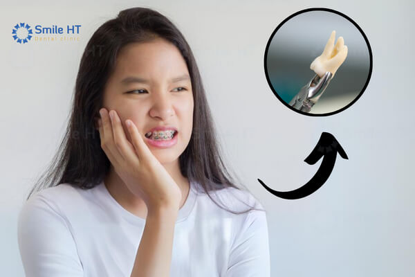 Nhổ răng khi niềng răng